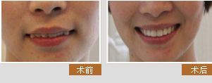 寧波牙博士高永峰醫(yī)生仿生美牙冠矯正前后對(duì)比圖展示