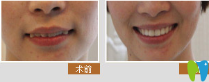 寧波牙博士口腔美牙冠矯正術(shù)前術(shù)后對(duì)比圖
