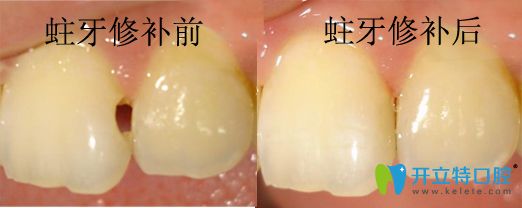 潮州眾信蛀牙修補前后對比