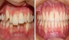 隱形矯正有用嗎？看自貢新橋口腔3D數(shù)碼隱形矯正案例效果