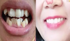 深圳拜博口腔一年半牙齒矯正結(jié)束啦，接下來(lái)開(kāi)始戴保持器