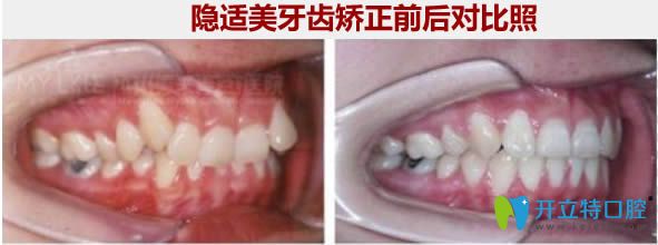 隱適美隱形矯正前后對(duì)比照