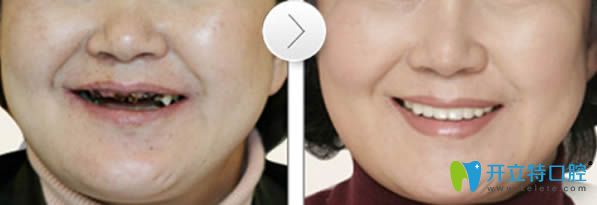 北京美年口腔<!--<i data=20240703-sp></i>-->波院長(zhǎng)老年人牙齒缺失種植牙前后對(duì)比效果
