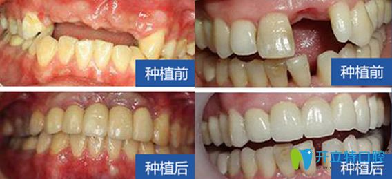 西安雁塔惟真口腔怎么樣？百萬(wàn)真實(shí)案例，彰顯種植優(yōu)勢(shì)