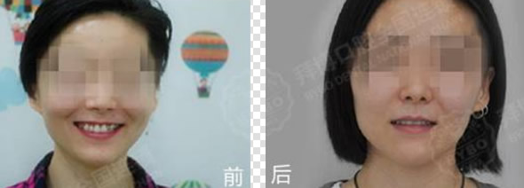 天津拜博口腔整牙價(jià)錢貴嗎 我做時(shí)代天使隱形矯正花了2萬(wàn)1