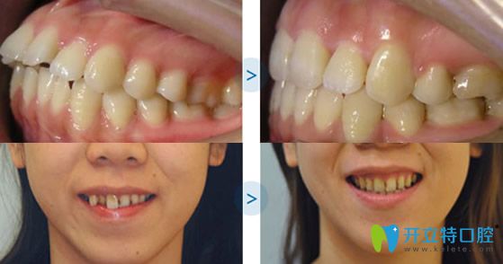 福州維樂口腔牙齒矯正術前術后對比案例