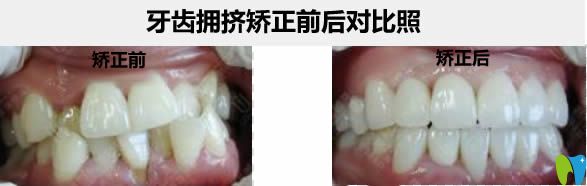 哈爾濱圣琪王曉琳院長(zhǎng)牙齒擁擠不拔牙矯正前后對(duì)比照