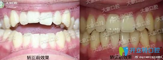 從哈爾濱大象牙科價(jià)目表及口碑評(píng)價(jià)看大象口腔貴不貴