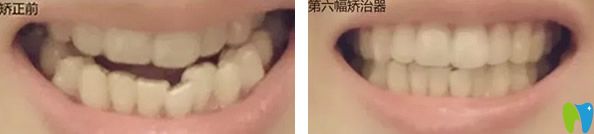 矯正前和戴第六幅隱形牙套正畸效果對(duì)比