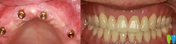 <!--<i data=20240703-sp></i>-->雅悅齒科全口無牙種植牙前后效果對(duì)比圖