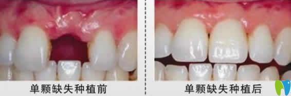 ?？趪趴谇恍煅娣N植牙案例效果圖