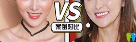 牙博士口腔泉州補(bǔ)牙哪家好？來看牙博士口腔補(bǔ)牙治療前后對(duì)比案例