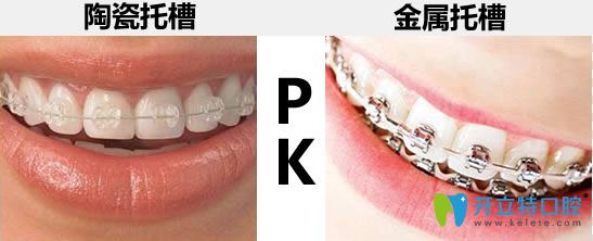 陶瓷和金屬矯正器圖示