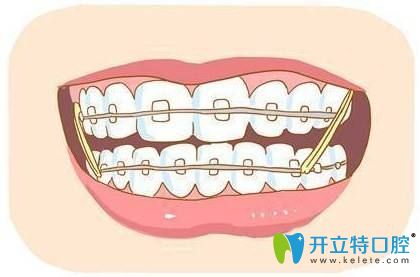 牙齒矯正中容易長(zhǎng)蛀牙是真的嗎