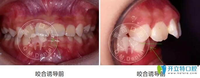 兒童咬合誘導(dǎo)哪家好？深圳青苗口腔羅慕咬合矯正案例驗(yàn)證
