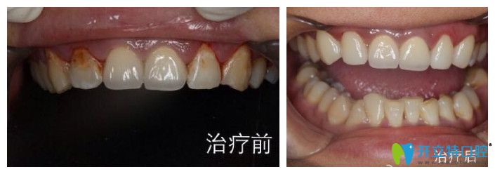 <!--<i data=20240703-sp></i>-->口腔趙中華怎么樣？來看真人案例效果