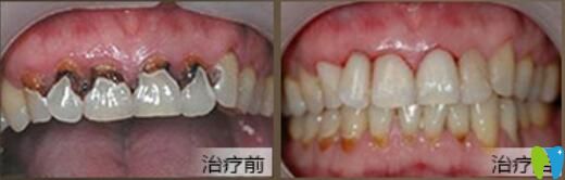 北京中諾口腔好不好？郭祖迎牙齒修復(fù)案例效果來驗(yàn)證