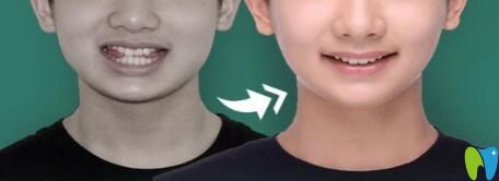 重慶華美口腔丁愛軍怎么樣？真人案例來驗證