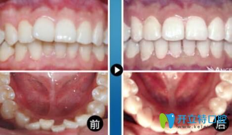 重慶華美口腔王偉好不好？真人牙齒矯正案例效果公布