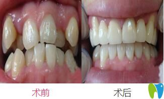 戴時(shí)代天使隱形矯正器矯正擁擠不齊牙齒案例前后效果對比