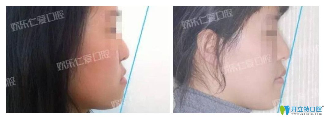 沈陽歡樂口腔怎么樣？肖春正畸案例公布