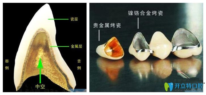 注意,烤瓷牙變成這樣就要及時(shí)拆除啦！