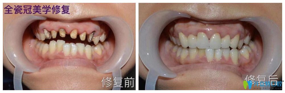 逸盛口腔口腔烤瓷牙失敗全瓷牙修復(fù)案例前后效果對比