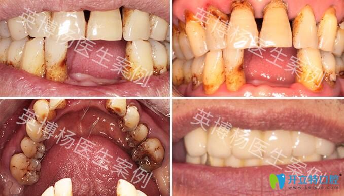 <!--<i data=20240703-sp></i>-->英博口腔種植牙好不好？來(lái)看夏偉院長(zhǎng)種植牙過(guò)程案例