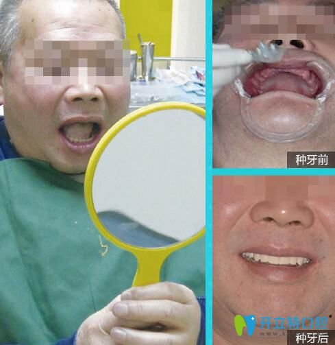 維樂(lè)口腔56歲余先生全口牙即刻負(fù)重種植案例