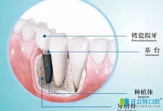 維樂(lè)口腔種植牙是由基臺(tái)、種植體組成圖示