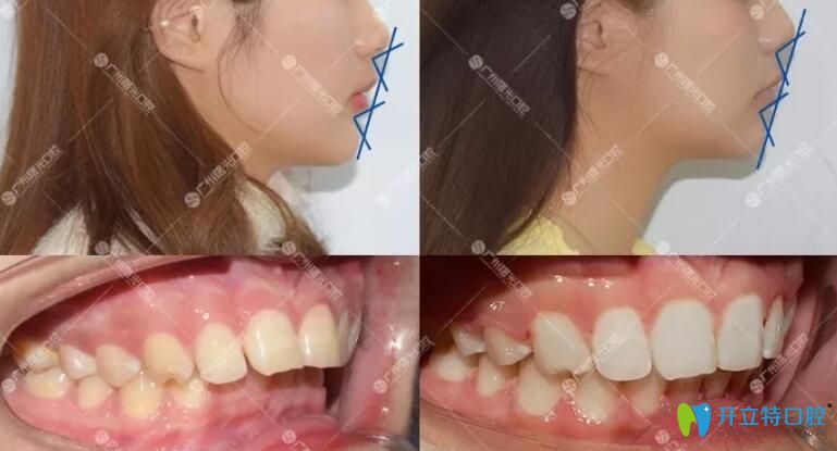 廣州曙光醫(yī)院?jiǎn)T工矯正牙齒案例