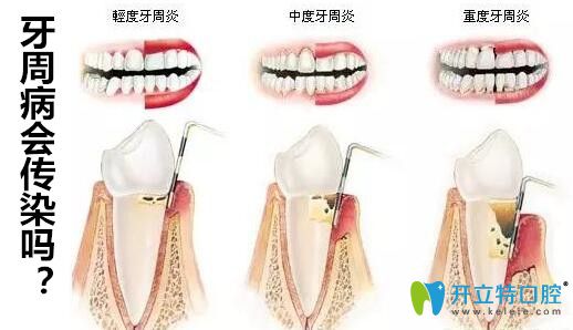 牙周病會(huì)傳染給別人嗎?醫(yī)生說(shuō)只要注意這4件事就遠(yuǎn)離牙周炎