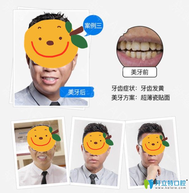 廣州瓷貼面哪家做的好？在曙光口腔做了牙貼面顧客用效果來說話