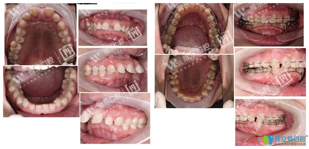 北京維樂(lè)口腔不知道去北京哪里做牙齒矯正不妨看下維樂(lè)口腔譚暉的案例