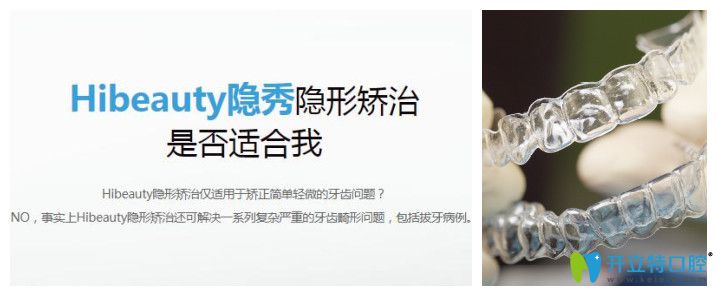 隱秀隱形牙套的優(yōu)勢