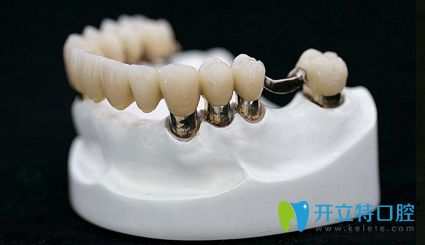 套筒冠義齒修復牙齒松動