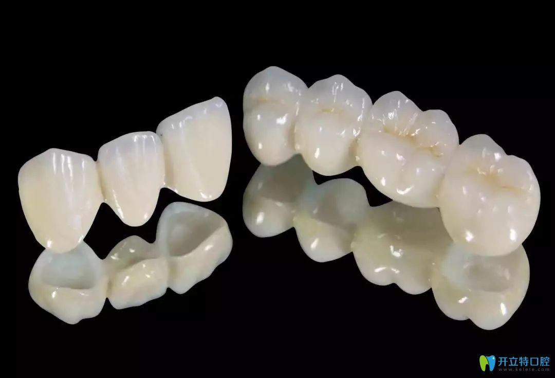 全瓷牙的圖片