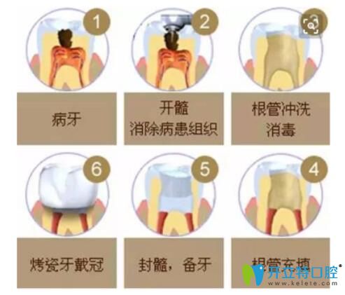 根管治療過(guò)程圖示