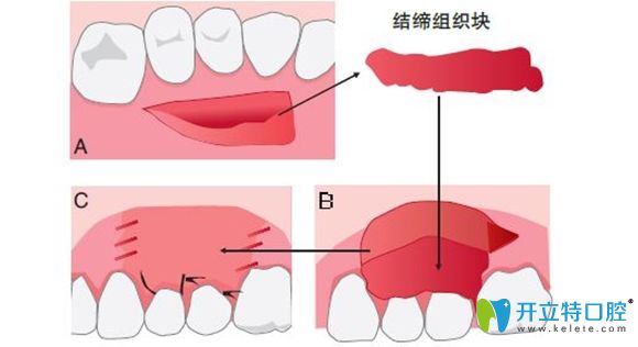 牙齒修補(bǔ)手術(shù)過(guò)程圖解