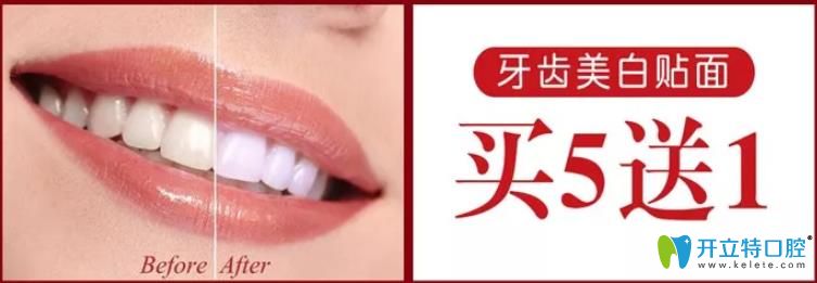 廈門(mén)登特口腔牙齒貼面活動(dòng)