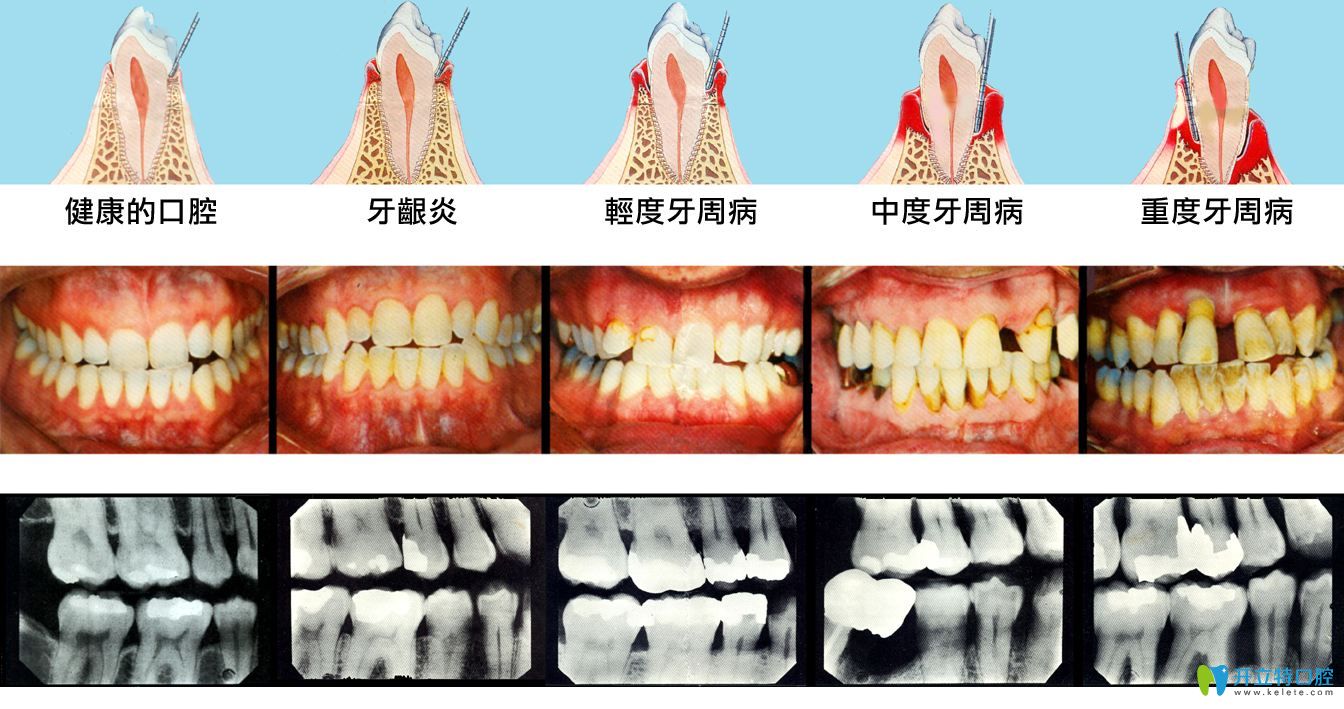 牙周炎牙齒松動怎么辦,需不需要拔牙要看能否固定恢復(fù)