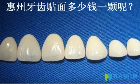 關(guān)注惠州牙齒貼面多少錢時,更需了解做瓷貼面的危害和優(yōu)勢