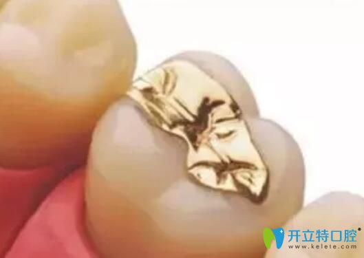 嵌體補(bǔ)牙