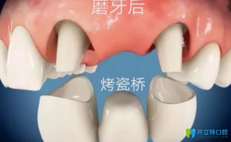剛戴上全瓷牙咬東西疼是咋回事？趕緊戳進(jìn)來看看吧