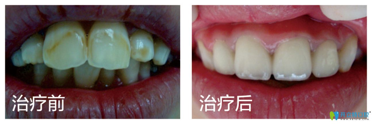 黃牙妹子看過(guò)氟斑牙做完皓齒美白的前后對(duì)比照,你不心動(dòng)嗎
