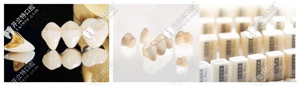 牙齒缺損了做烤瓷牙還是瓷睿刻啊,做過的說說哪個(gè)好