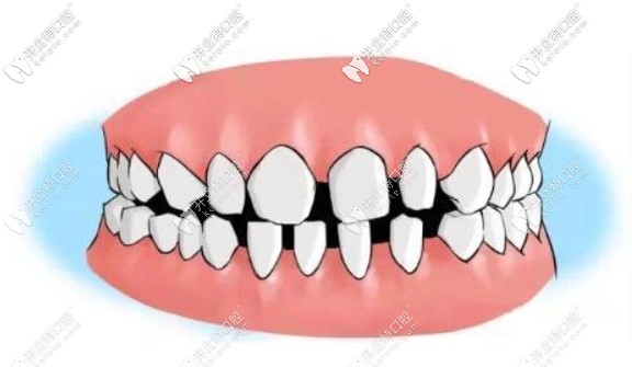 我的牙縫很大，到底需不需要補(bǔ)呀