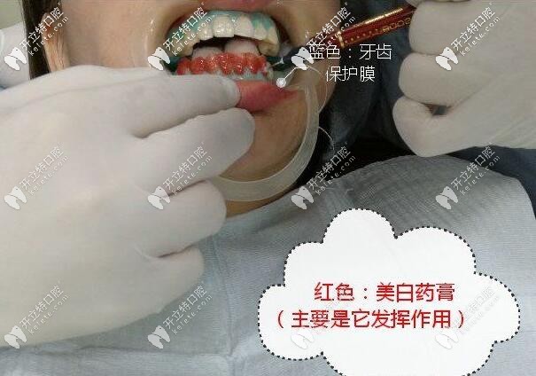 皓齒美白步驟