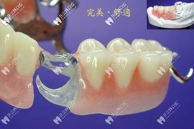 干貨來了：同為臨時(shí)牙冠的即刻義齒和臨時(shí)義齒有區(qū)別嗎？