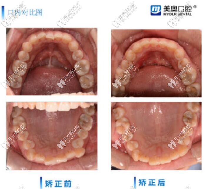 長沙美奧口腔時(shí)代天使推磨牙案例